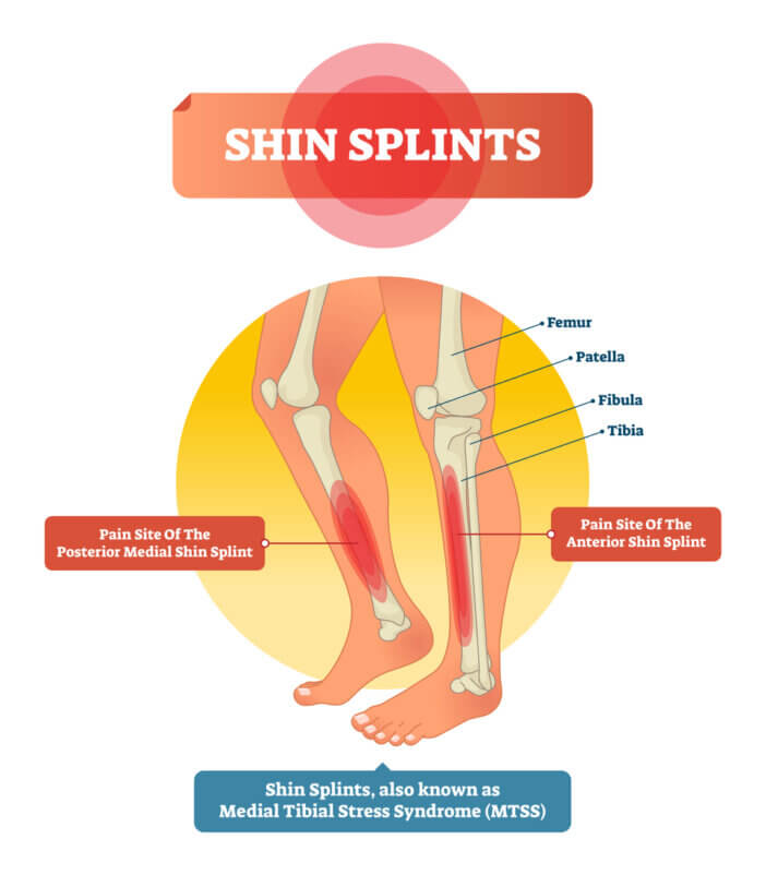 Shin splints vector illustration. Leg muscle sport trauma and bone pain labeled diagram. Isolated femur, patella, fibula, tibia and foot bones with shown injury location.